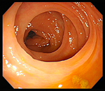 下部消化管内視鏡検査（大腸カメラ）
