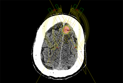 脳転移に対する定位放射線治療(SRT)