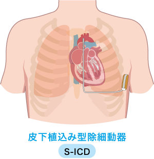 皮下植込み型除細動器 S-ICD