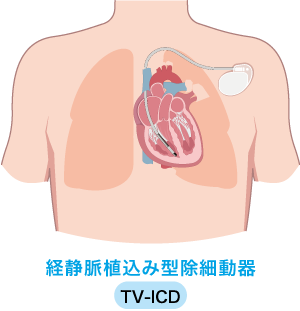 経静脈植込み型除細動器 TV-ICD
