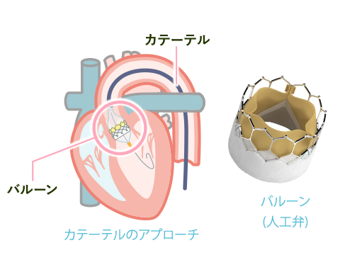 TAVI(経カテーテル大動脈弁留置術)とは