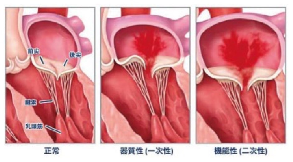 機能性僧帽弁閉鎖不全症