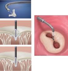 Mitral clipの実際