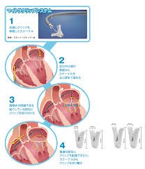 Mitral clipの実際
