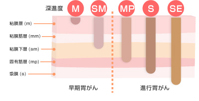 ESD（内視鏡的粘膜下層剥離術）