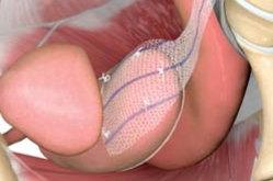 腹腔鏡下仙骨腟固定術(Laparoscopic　Sacrocolpopexy：LSC)