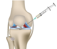 Regenerative Medicine: PRP Therapy (Private Practice)