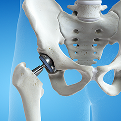 人工股関節置換手術(THA:Total Hip Arthroplasty)