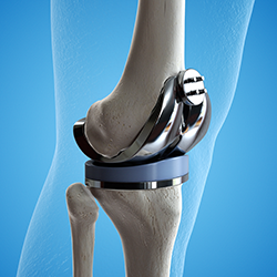 人工膝関節置換術(TKA:Total Knee Arthroplasty)