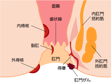 当院では、肛門の痛み、出血、腫れ、かゆみなど、おしりのトラブル全般に対応しております