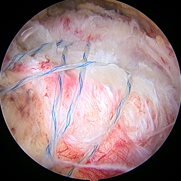 関節鏡下腱板修復術