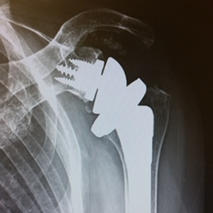 リバース型人工関節