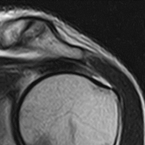 左腱板不全～完全断裂