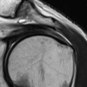 左腱板不全～完全断裂