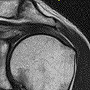 左腱板不全～完全断裂