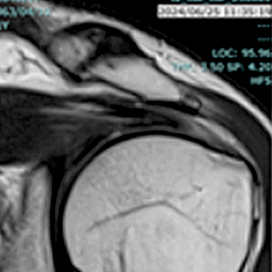 左肩腱板完全断裂