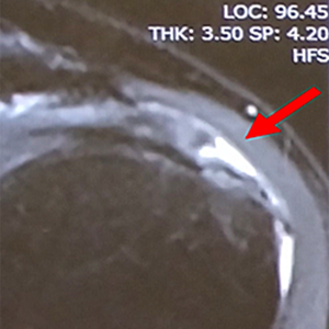 左腱板不全断裂