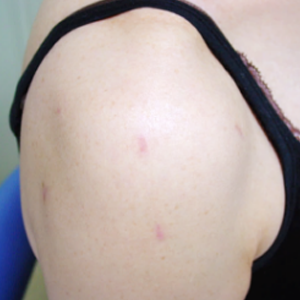 腱板断裂の治療