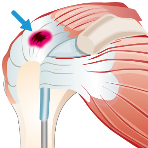 肩腱板断裂 イラスト