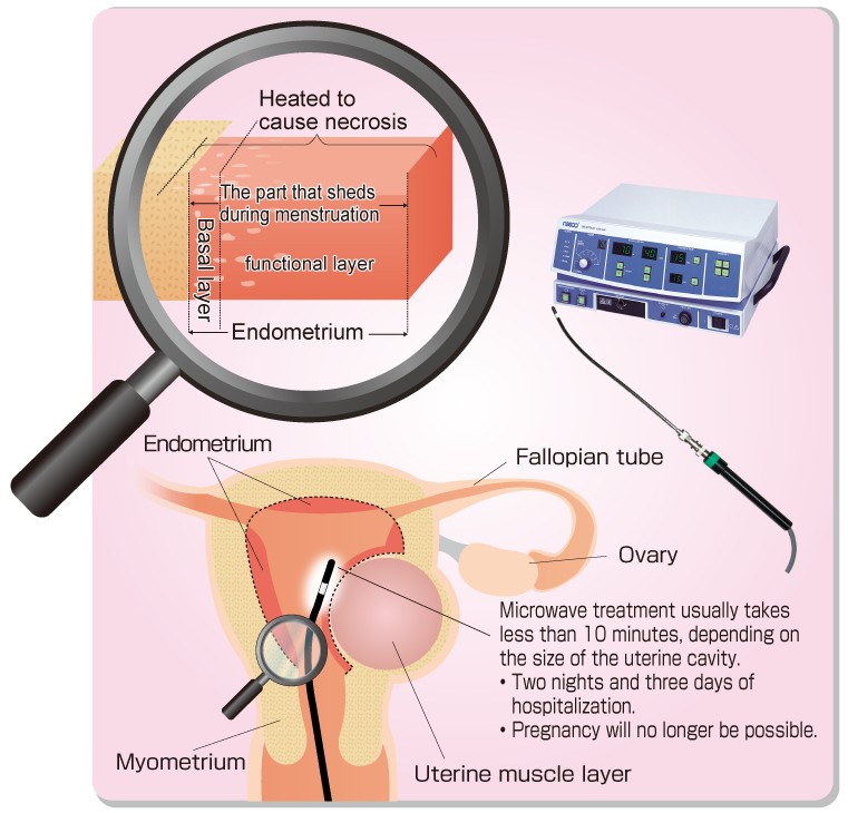 Non-Incisional Treatment: MEA (Microwave Endometrial Ablation)