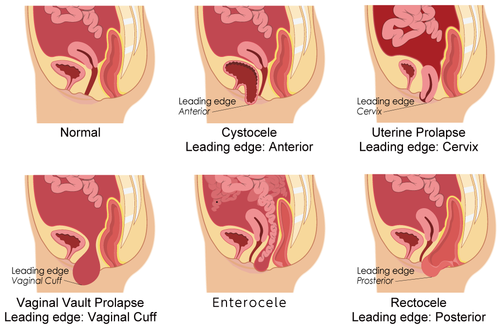 Types of Pelvic Organ Prolapse