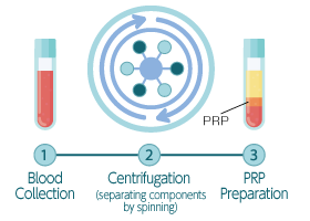 What is PRP (Platelet-Rich Plasma)?