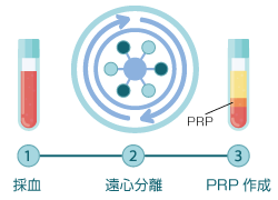 PRP(Platelet-rich plasma:PRP)とは
