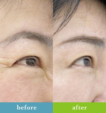 ボトックス注射