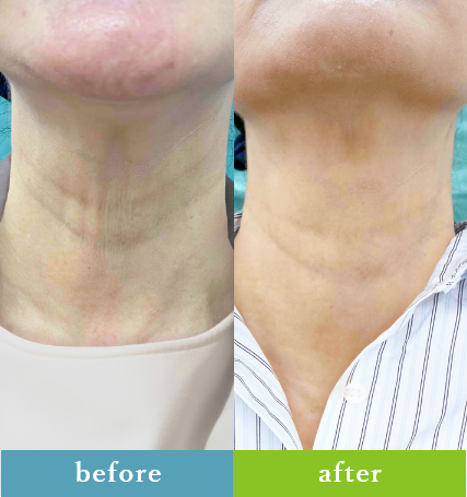 ボトックス注射